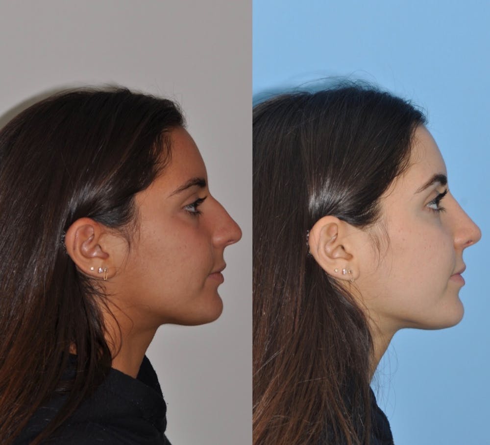 Rhinoplasty Before & After Gallery - Patient 31710049 - Image 5