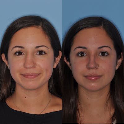 Rhinoplasty Before & After Gallery - Patient 31710050 - Image 1