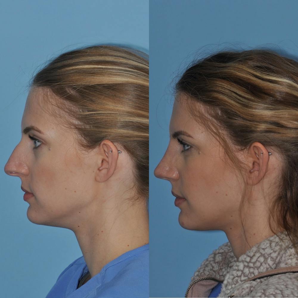 Rhinoplasty Before & After Gallery - Patient 31710052 - Image 1