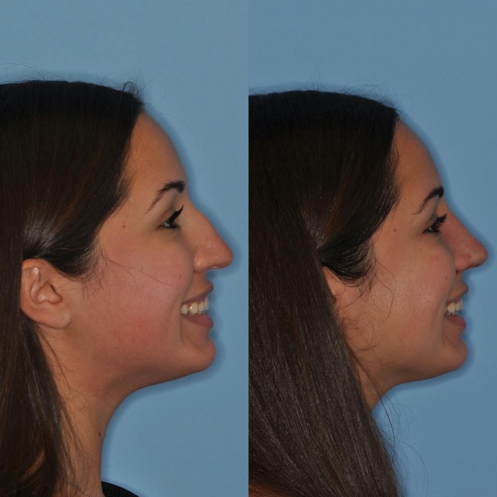 Rhinoplasty Before & After Gallery - Patient 31710050 - Image 2