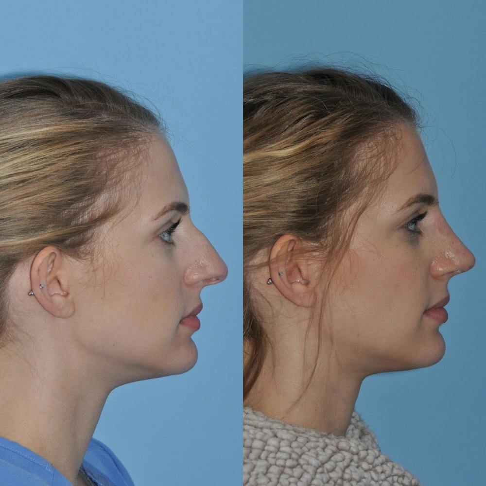 Rhinoplasty Before & After Gallery - Patient 31710052 - Image 2