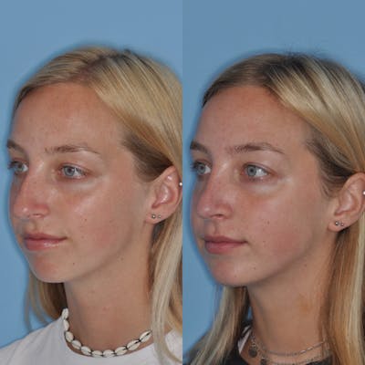 Rhinoplasty Before & After Gallery - Patient 31710053 - Image 1