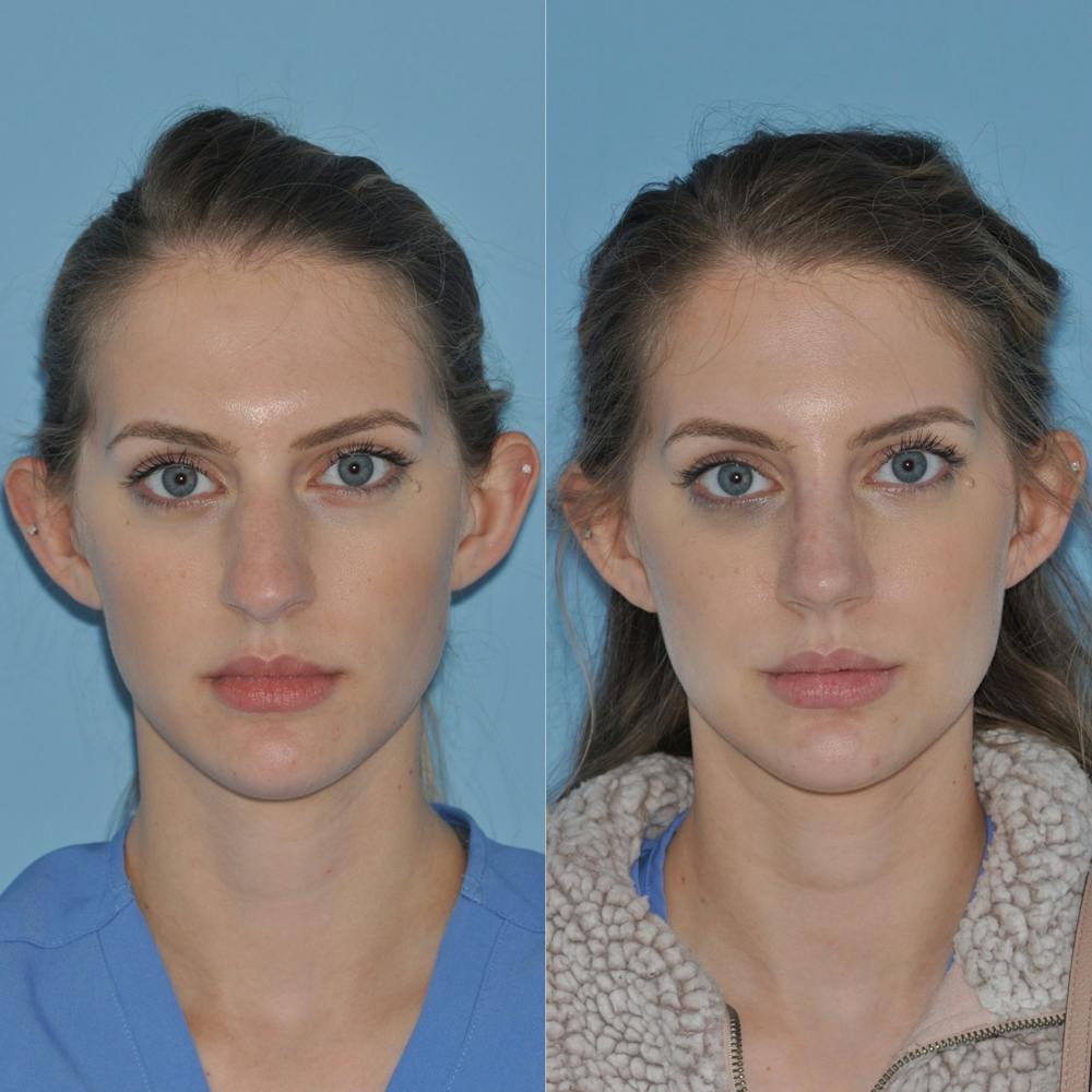 Rhinoplasty Before & After Gallery - Patient 31710052 - Image 3