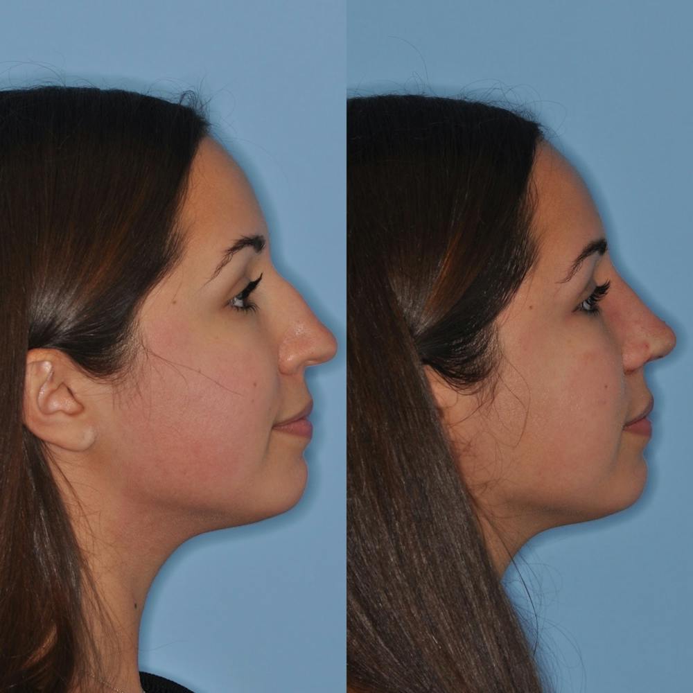 Rhinoplasty Before & After Gallery - Patient 31710050 - Image 4