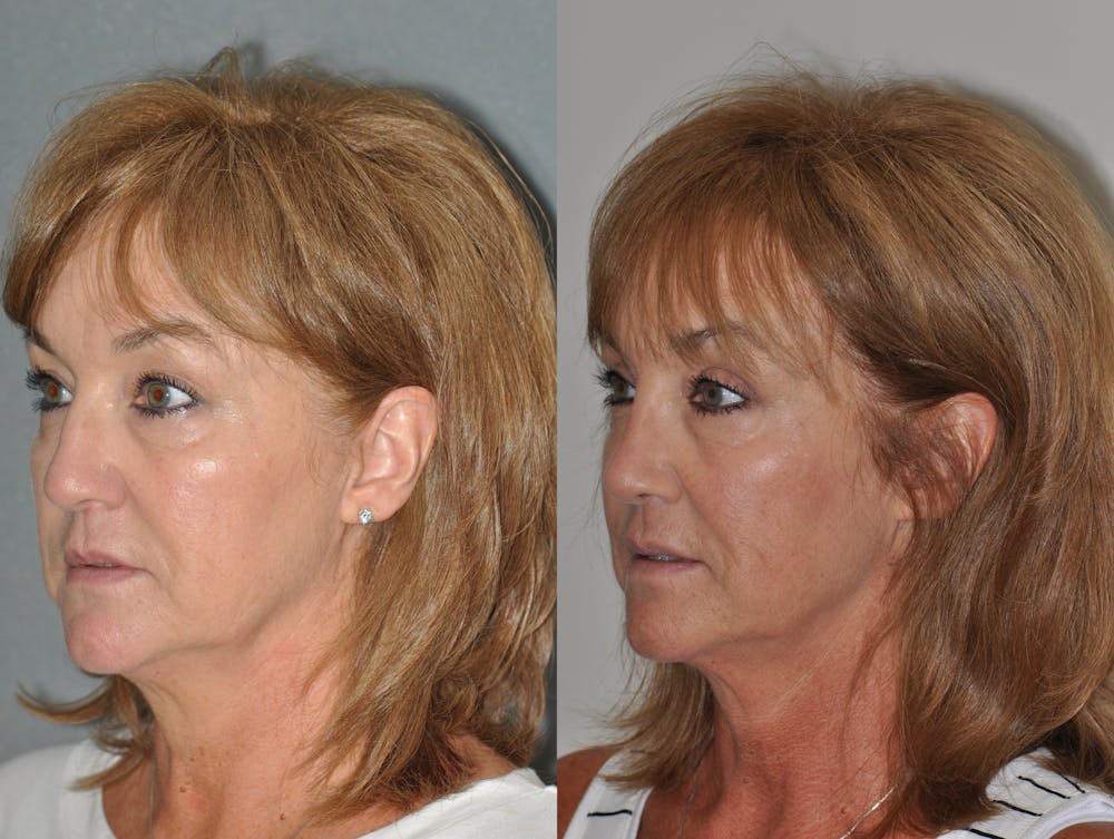 Rhinoplasty Before & After Gallery - Patient 31710051 - Image 4