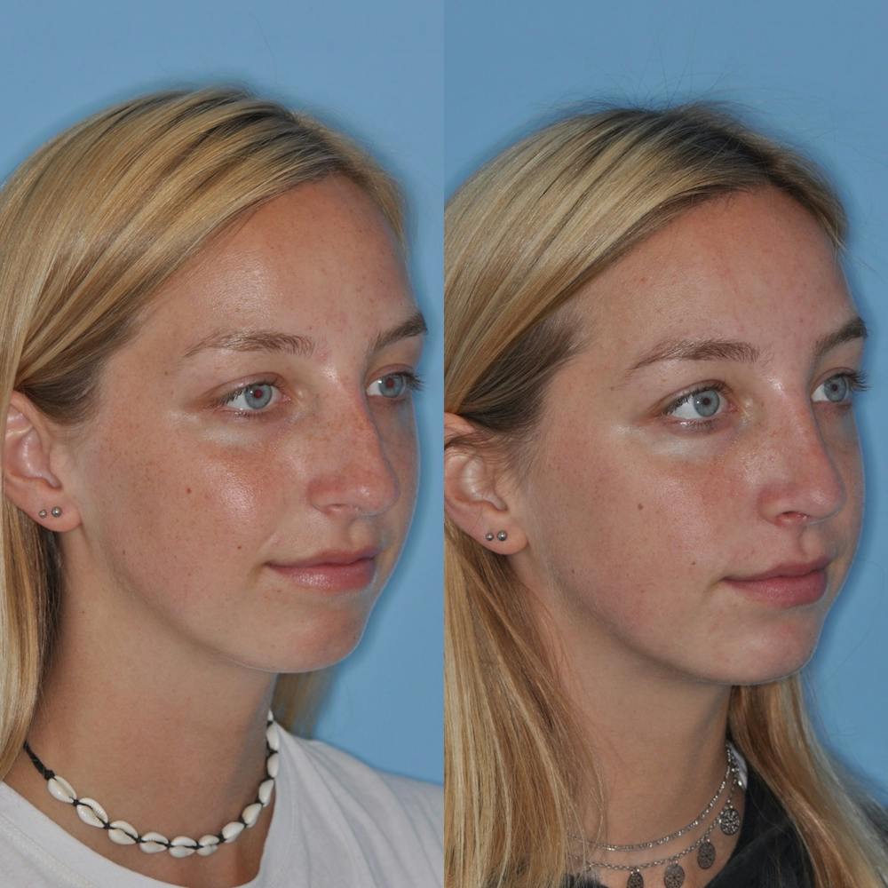 Rhinoplasty Before & After Gallery - Patient 31710053 - Image 3