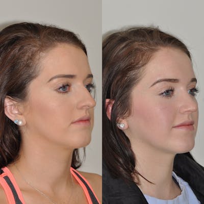 Rhinoplasty Before & After Gallery - Patient 31710054 - Image 1