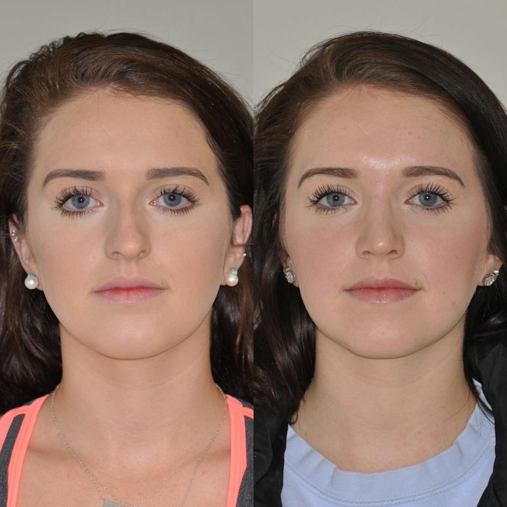 Rhinoplasty Before & After Gallery - Patient 31710054 - Image 2