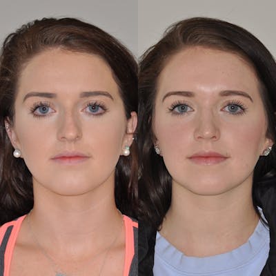 Rhinoplasty Before & After Gallery - Patient 31710054 - Image 2