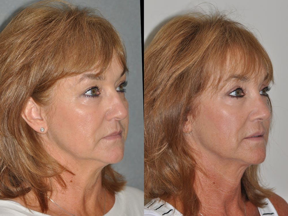 Rhinoplasty Before & After Gallery - Patient 31710051 - Image 5