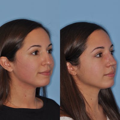 Rhinoplasty Before & After Gallery - Patient 31710050 - Image 6