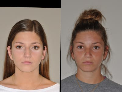 Rhinoplasty Before & After Gallery - Patient 31710055 - Image 1