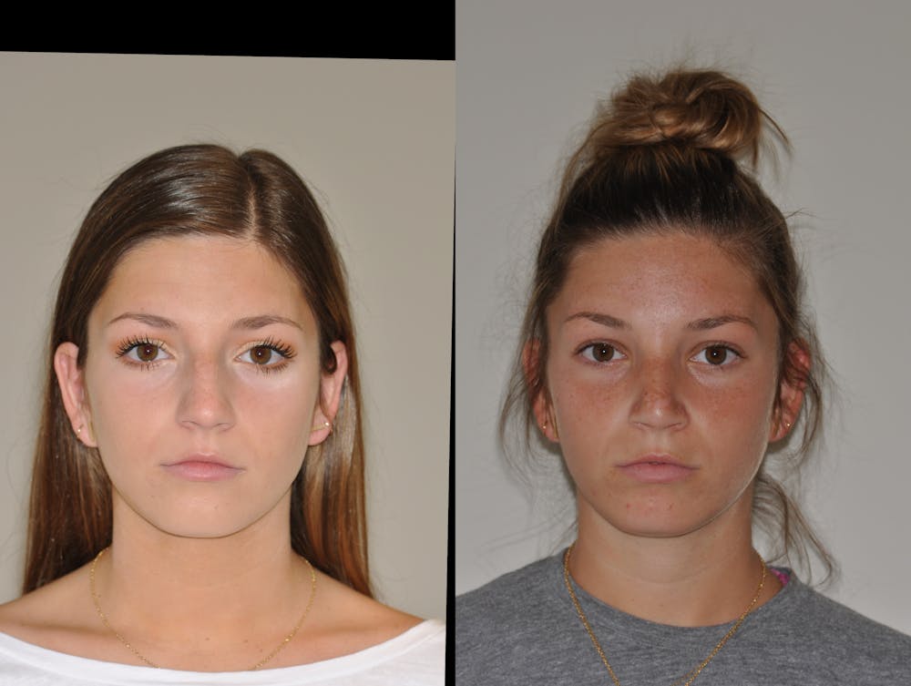 Rhinoplasty Before & After Gallery - Patient 31710055 - Image 1