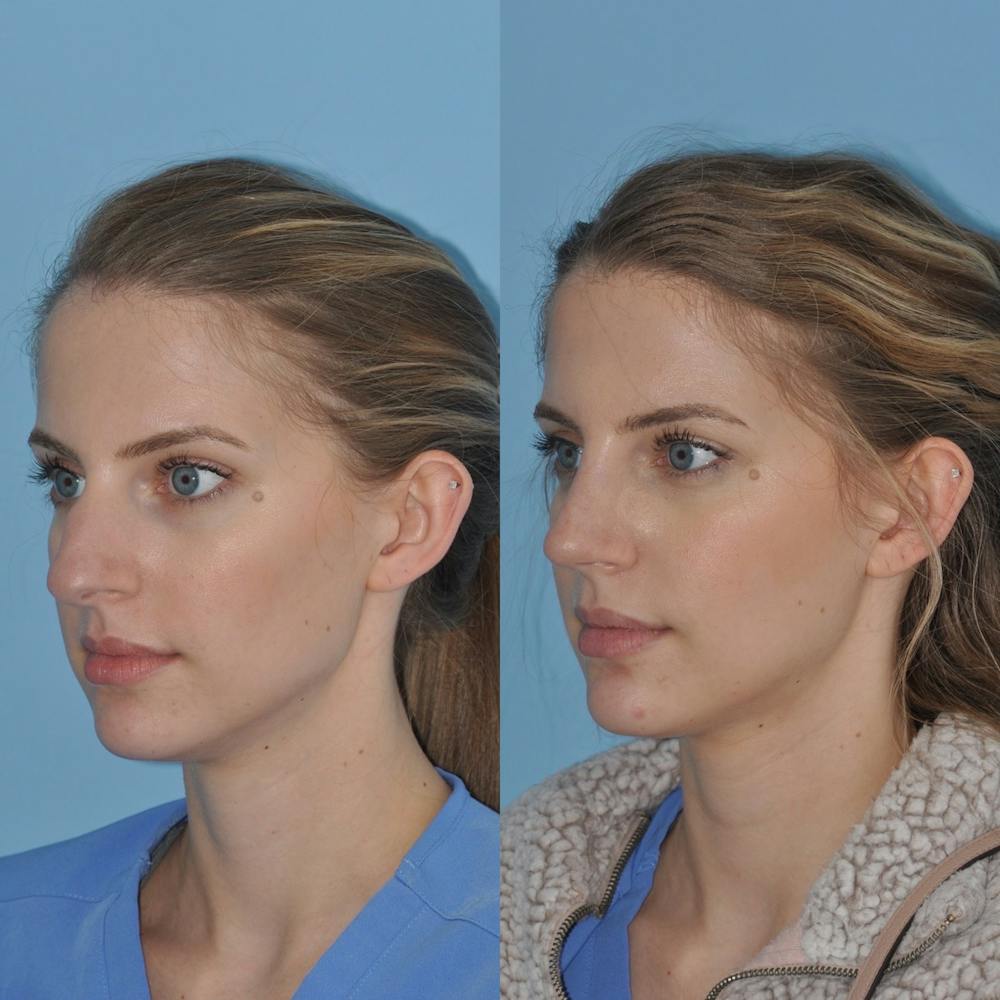 Rhinoplasty Before & After Gallery - Patient 31710052 - Image 5
