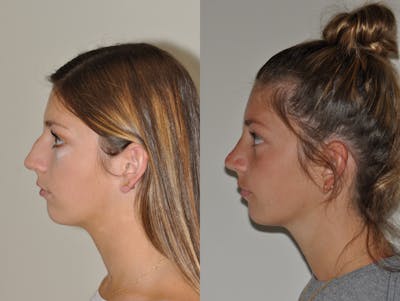 Rhinoplasty Before & After Gallery - Patient 31710055 - Image 2