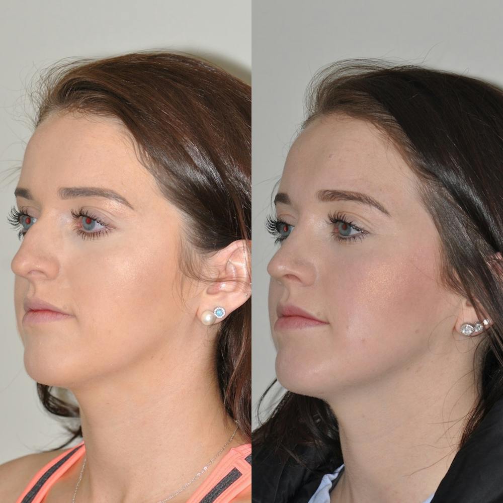 Rhinoplasty Before & After Gallery - Patient 31710054 - Image 3
