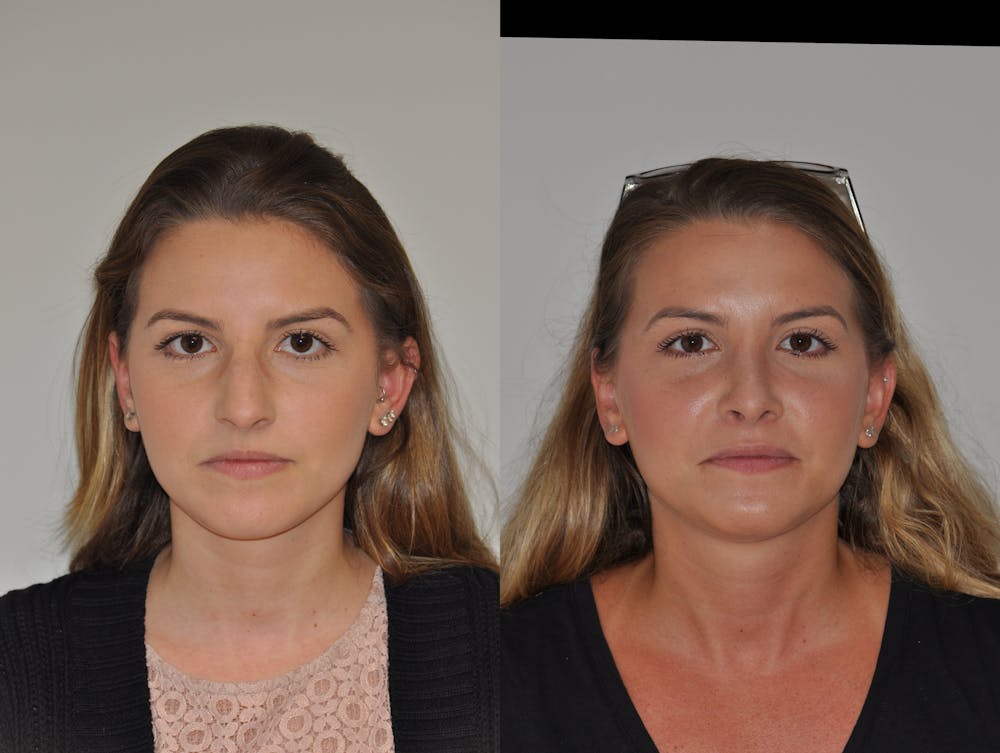 Rhinoplasty Before & After Gallery - Patient 31710058 - Image 1