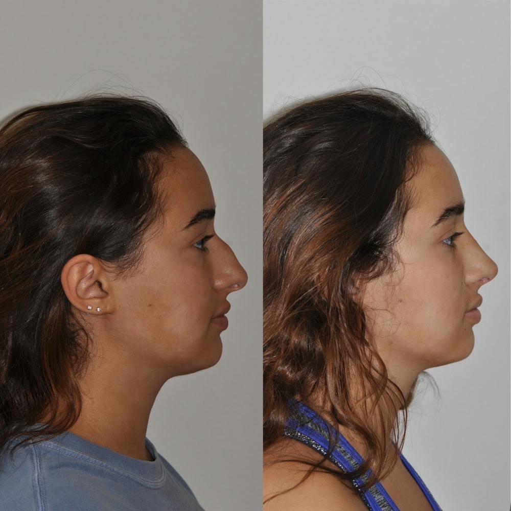 Rhinoplasty Before & After Gallery - Patient 31710057 - Image 2