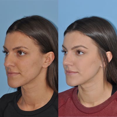 Rhinoplasty Before & After Gallery - Patient 31710059 - Image 1
