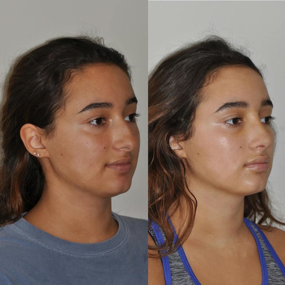 Rhinoplasty Before & After Gallery - Patient 31710057 - Image 3