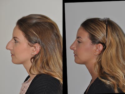 Rhinoplasty Before & After Gallery - Patient 31710058 - Image 2