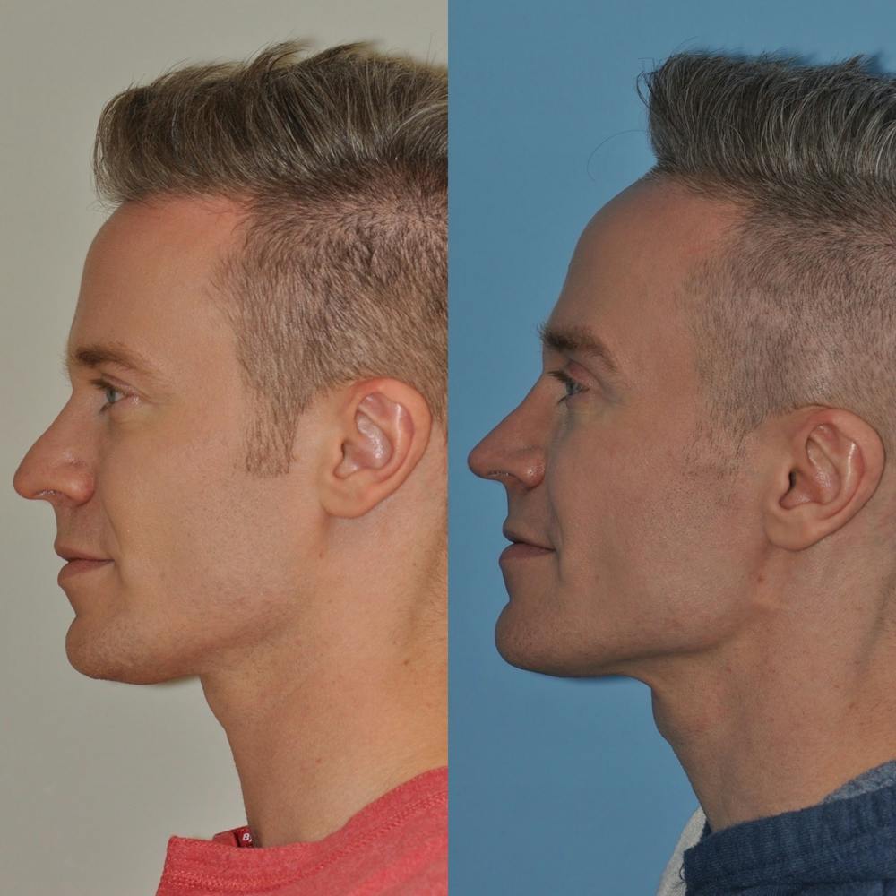 Rhinoplasty Before & After Gallery - Patient 31710060 - Image 1