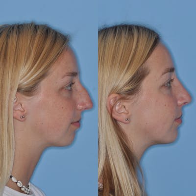 Rhinoplasty Before & After Gallery - Patient 31710053 - Image 6