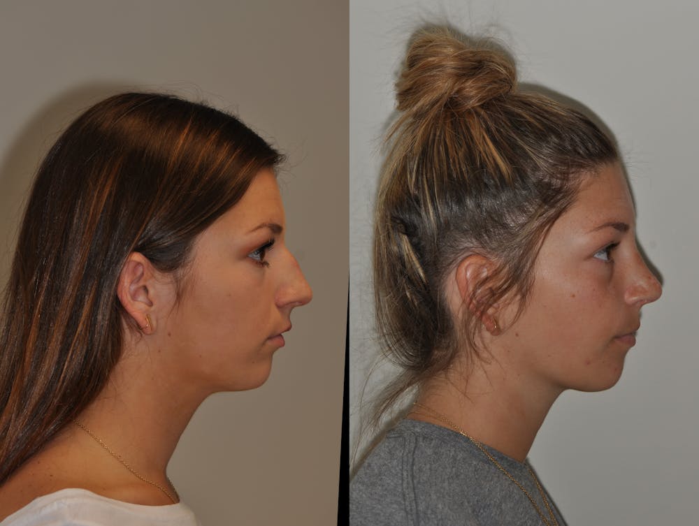 Rhinoplasty Before & After Gallery - Patient 31710055 - Image 3