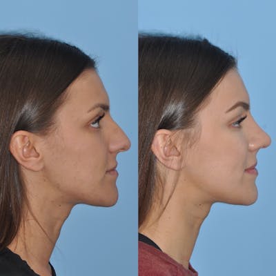 Rhinoplasty Before & After Gallery - Patient 31710059 - Image 2