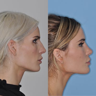 Rhinoplasty Before & After Gallery - Patient 31710061 - Image 1