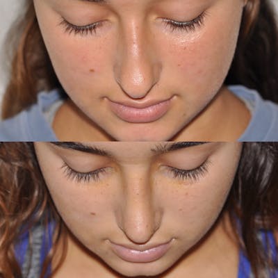 Rhinoplasty Before & After Gallery - Patient 31710057 - Image 4