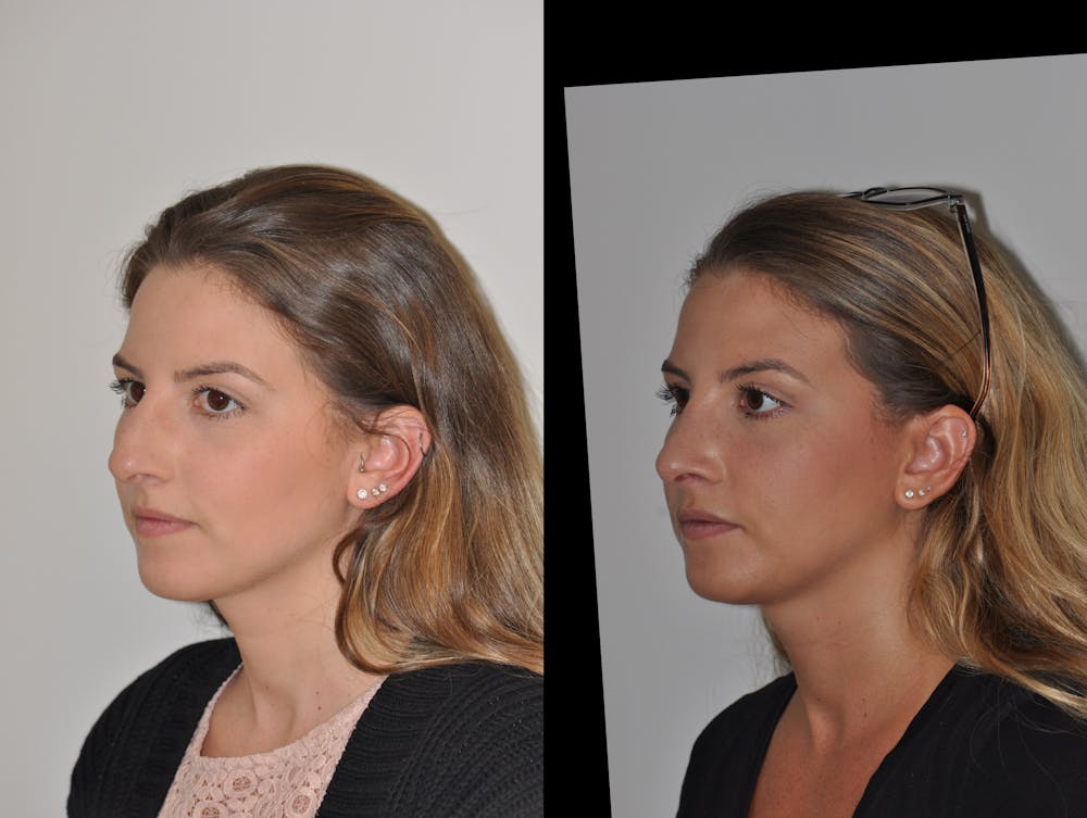 Rhinoplasty Before & After Gallery - Patient 31710058 - Image 3