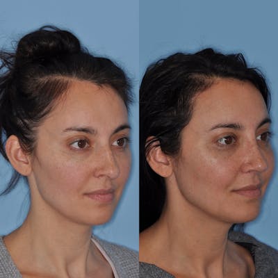 Rhinoplasty Before & After Gallery - Patient 31710062 - Image 1