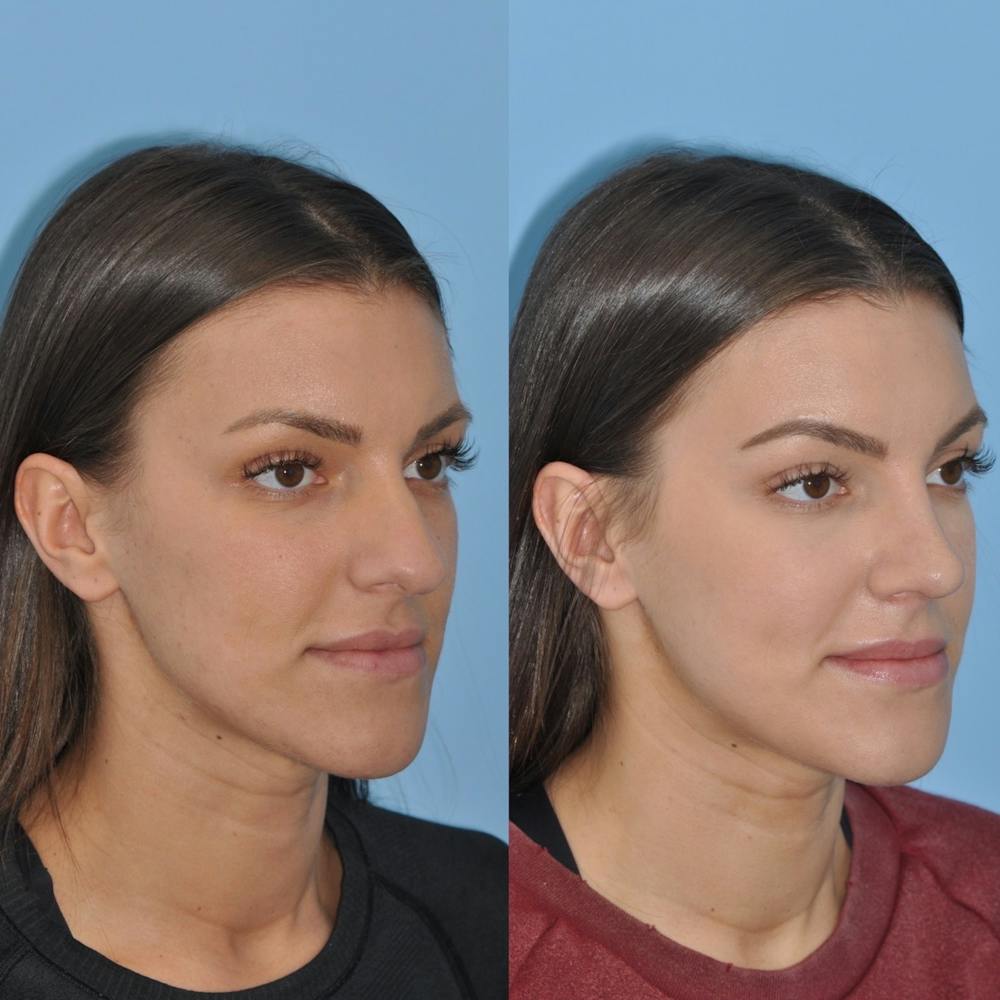 Rhinoplasty Before & After Gallery - Patient 31710059 - Image 3
