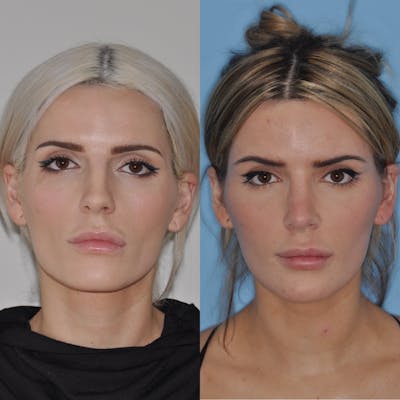 Rhinoplasty Before & After Gallery - Patient 31710061 - Image 2