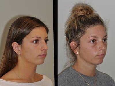Rhinoplasty Before & After Gallery - Patient 31710055 - Image 4