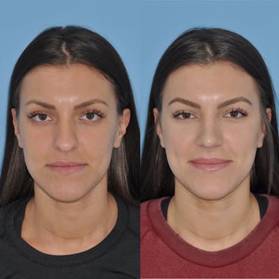 Rhinoplasty Before & After Gallery - Patient 31710059 - Image 4