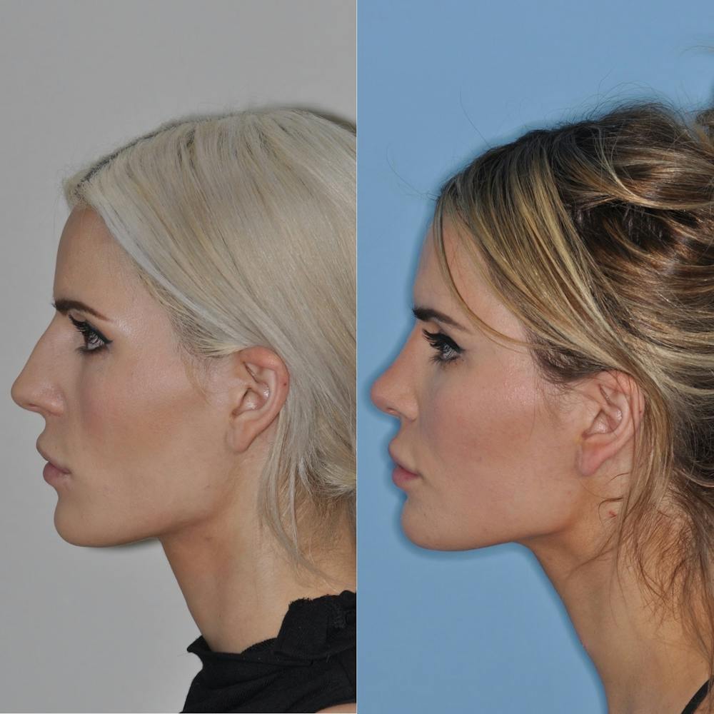 Rhinoplasty Before & After Gallery - Patient 31710061 - Image 3