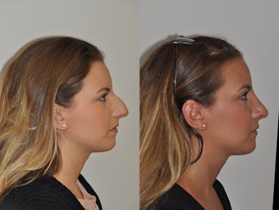 Rhinoplasty Before & After Gallery - Patient 31710058 - Image 4