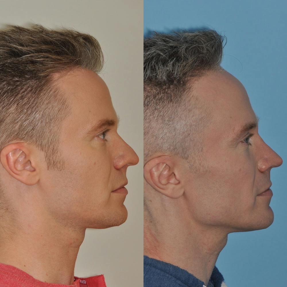 Rhinoplasty Before & After Gallery - Patient 31710060 - Image 4