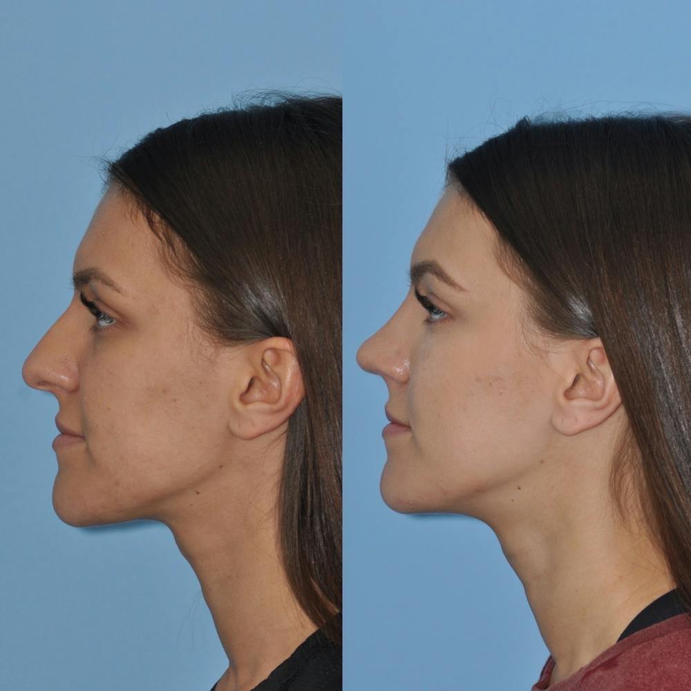 Rhinoplasty Before & After Gallery - Patient 31710059 - Image 5