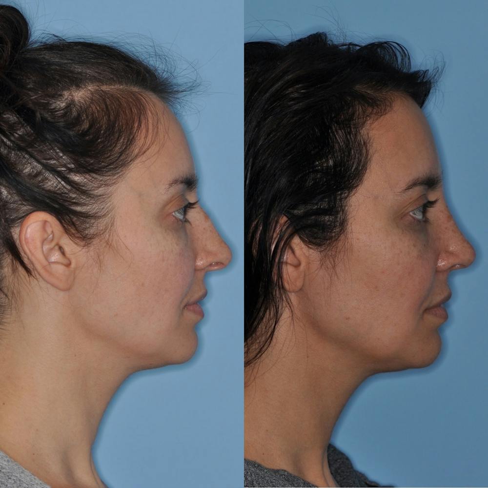 Rhinoplasty Before & After Gallery - Patient 31710062 - Image 3