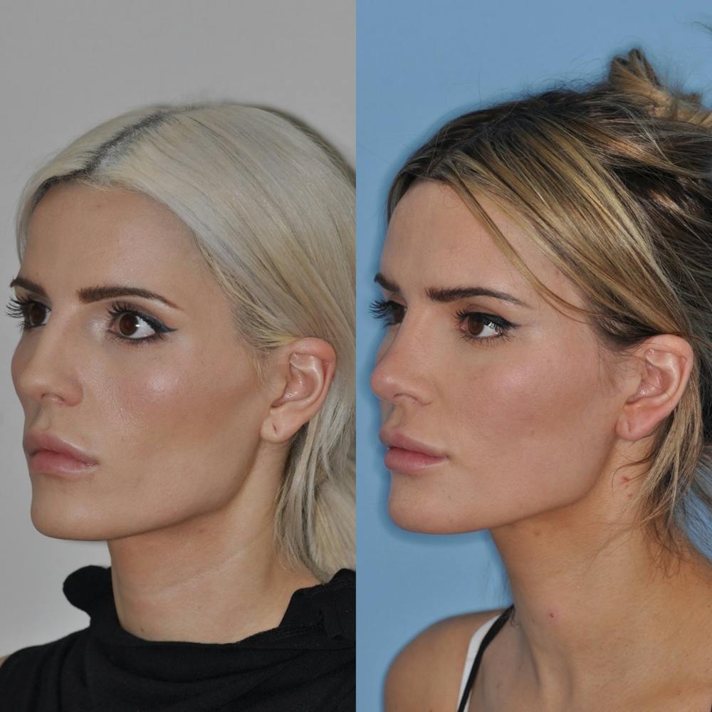 Rhinoplasty Before & After Gallery - Patient 31710061 - Image 4