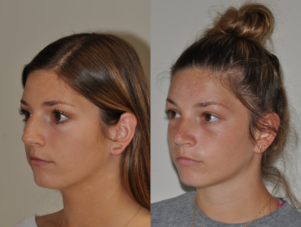 Rhinoplasty Before & After Gallery - Patient 31710055 - Image 5