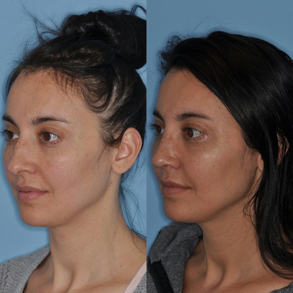 Rhinoplasty Before & After Gallery - Patient 31710062 - Image 4