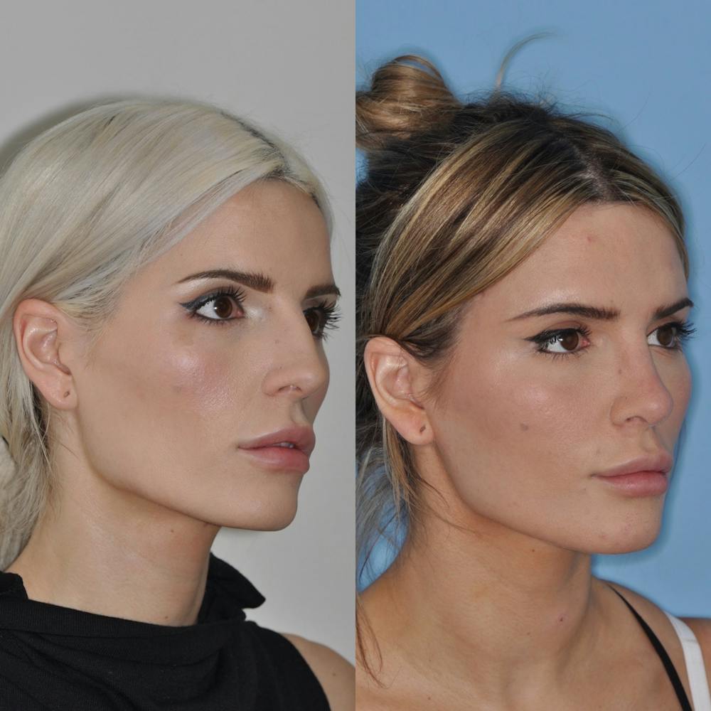 Rhinoplasty Before & After Gallery - Patient 31710061 - Image 5