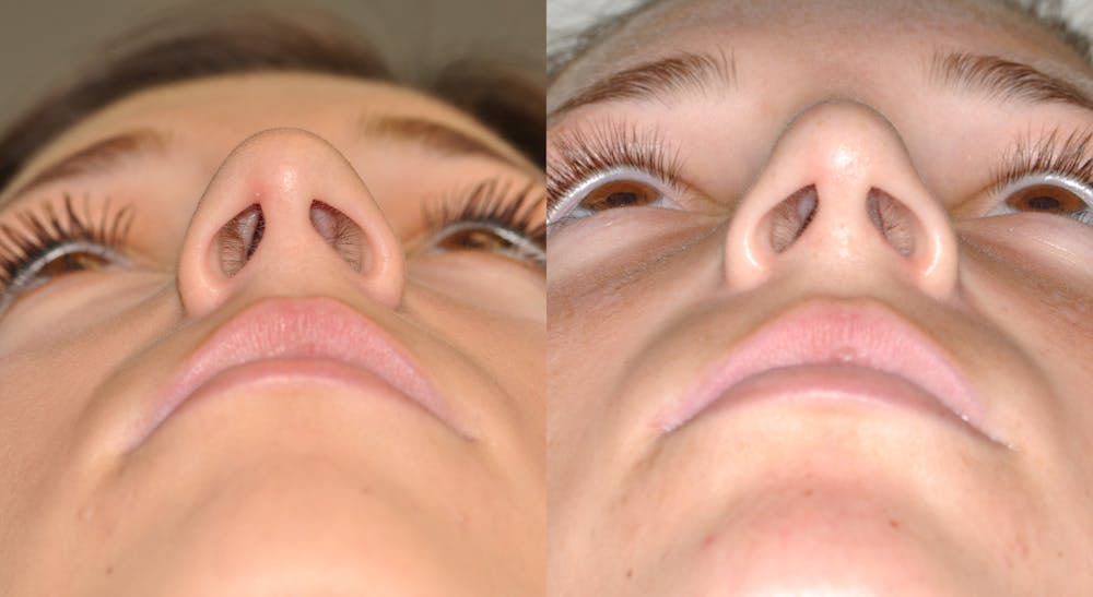 Rhinoplasty Before & After Gallery - Patient 31710055 - Image 6