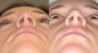 Rhinoplasty Before & After Gallery - Patient 31710055 - Image 6