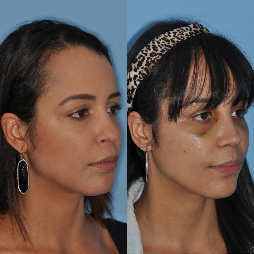 Rhinoplasty Before & After Gallery - Patient 31710063 - Image 1