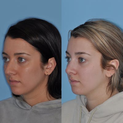 Rhinoplasty Before & After Gallery - Patient 31710064 - Image 1